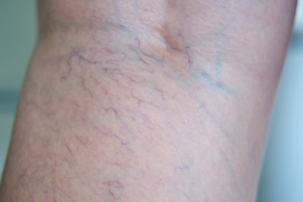 How Does Sclerotherapy Compare with Laser Treatment for Spider Veins?