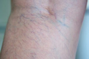 How Does Sclerotherapy Compare with Laser Treatment for Spider Veins?