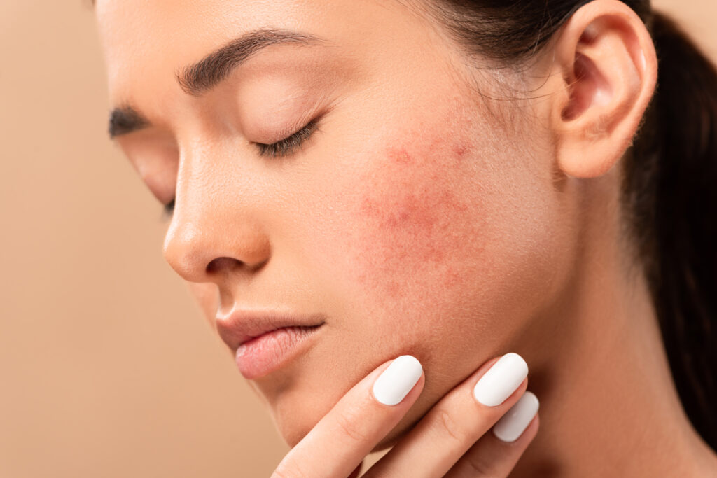 From Sun Spots to Rosacea: Real Ways BBL HEROic Transforms Florida-Damaged Skin