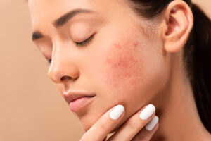 From Sun Spots to Rosacea: Real Ways BBL HEROic Transforms Florida-Damaged Skin